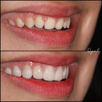 Before Treatment 1