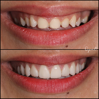 After Treatment 2