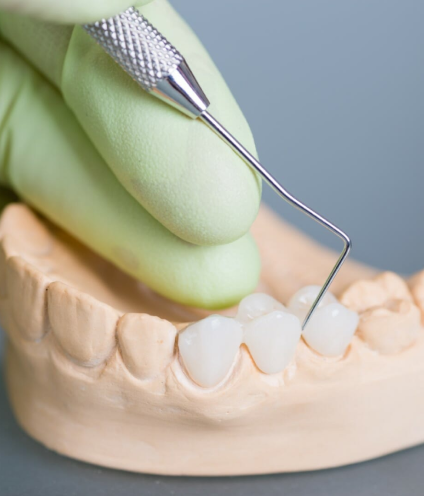 Dental Implants Treatment