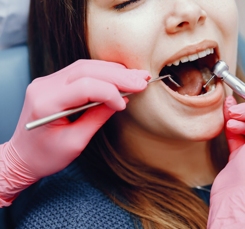 Tooth Bonding