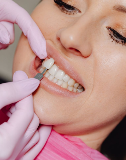 Smile Design Treatment