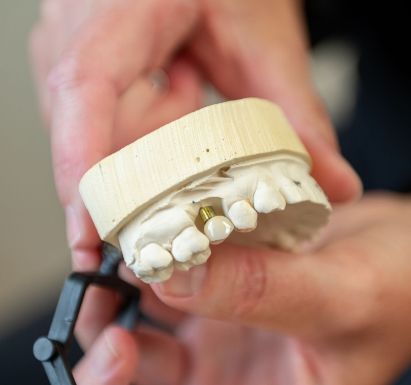 Dental Crown