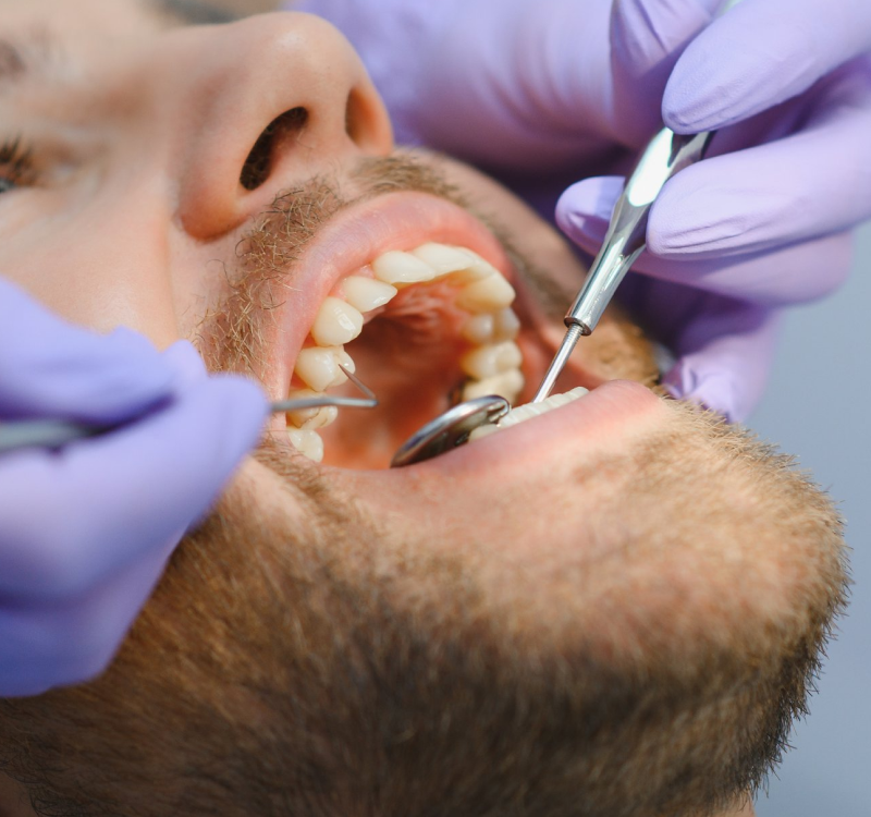 Tooth Bonding