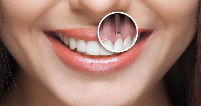 Smile Result