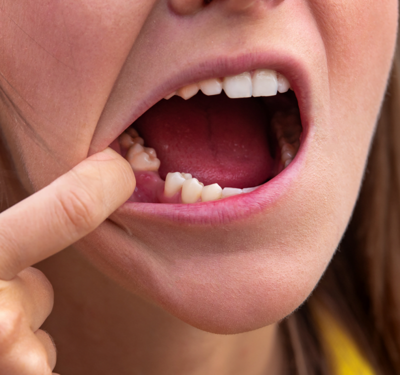 Tooth Bonding