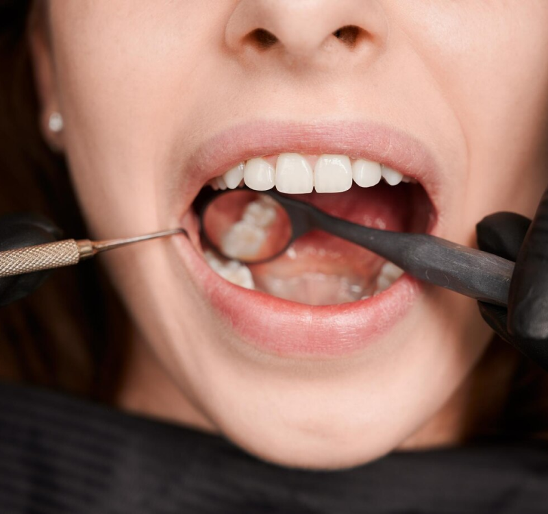 Dental Crown