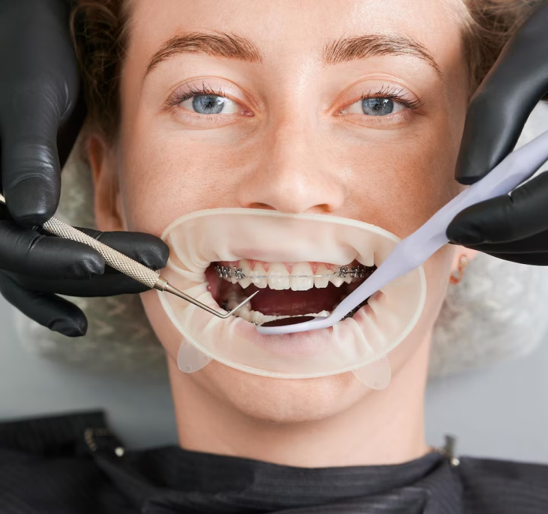 Tooth Bonding