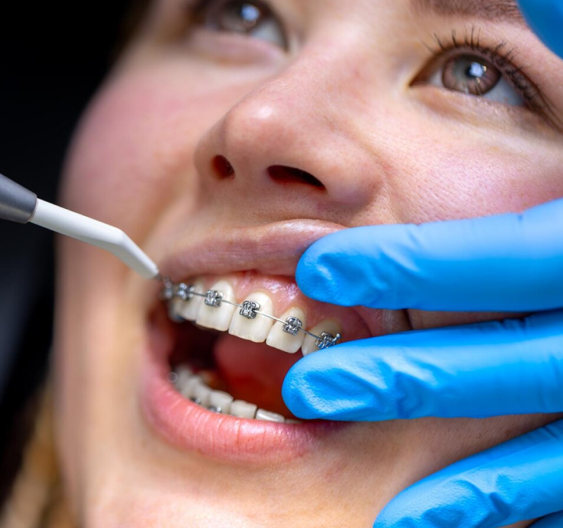 Dental Crown