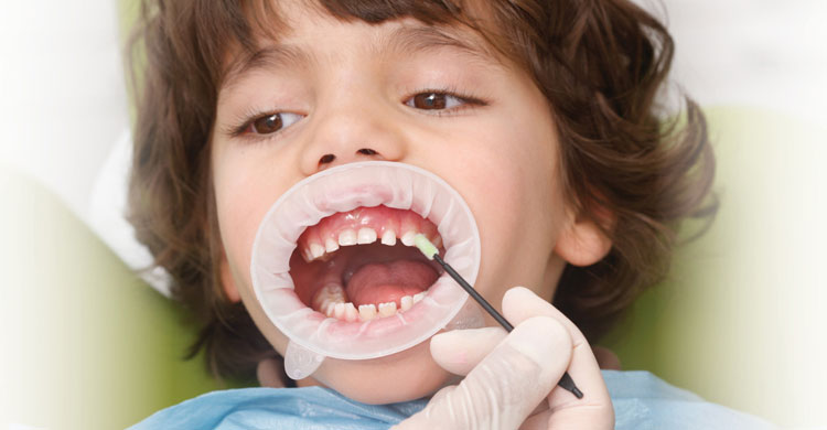 Topical Fluoride Treatment for Kids