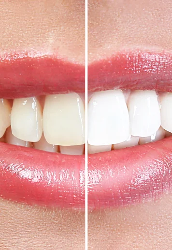 Instant Teeth Whitening Treatment