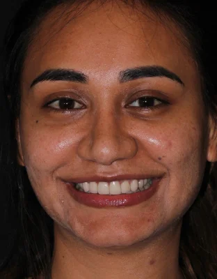 Happy Patient Smile 4