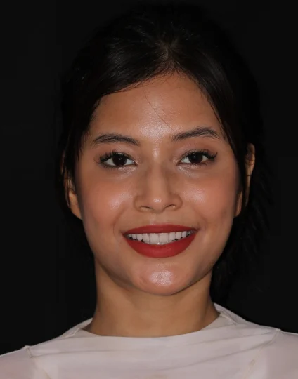 Smile Design Treatment