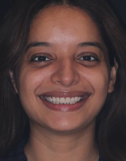 Smile Design Treatment