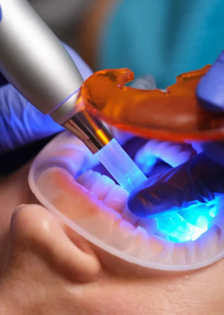 Smile Design Treatment