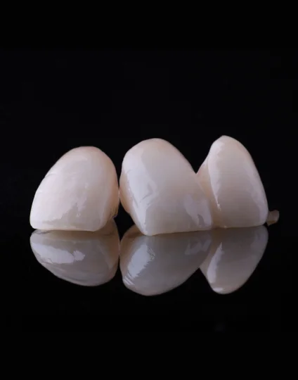 Smile Design Treatment