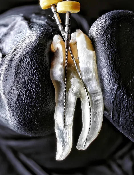 Smile Design Treatment