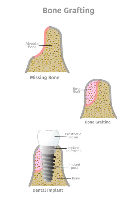 Smile Design Treatment