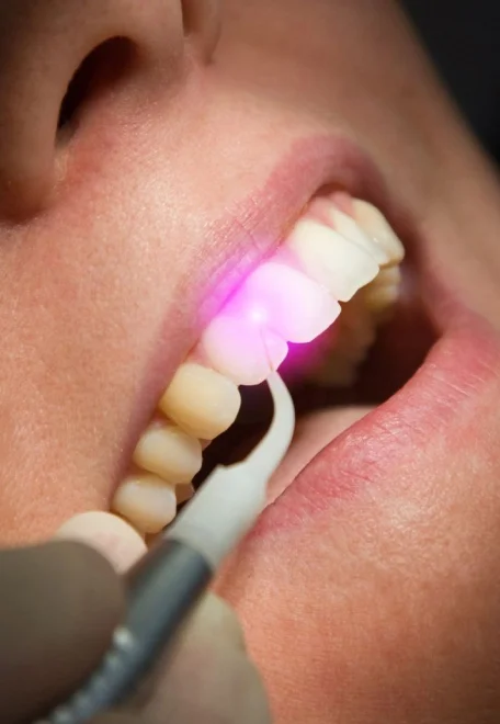 Smile Design Treatment